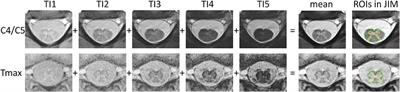 Normalization of Spinal Cord Total Cross-Sectional and Gray Matter Areas as Quantified With Radially Sampled Averaged Magnetization Inversion Recovery Acquisitions